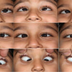 Lateral gaze in children