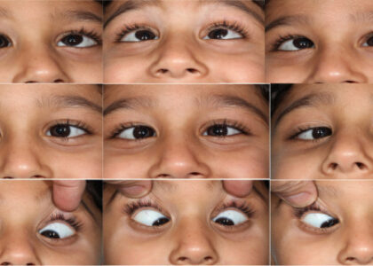 Lateral gaze in children