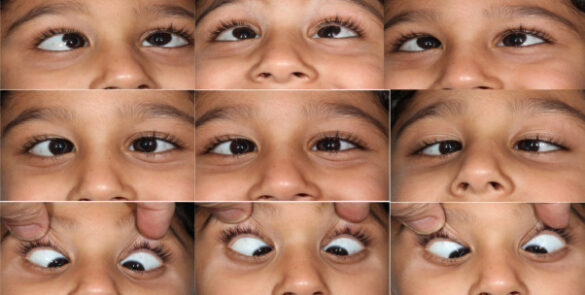 Lateral gaze in children