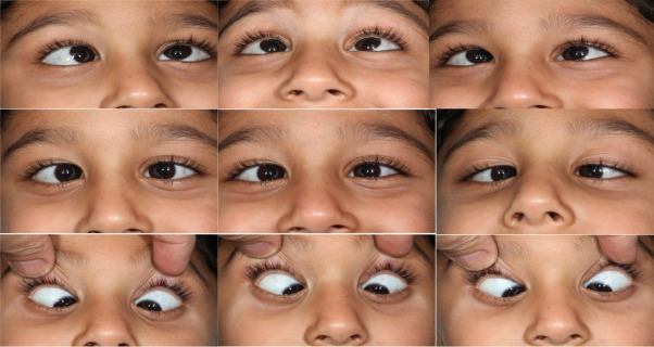 Lateral Gaze in Children: Understanding Sideways Eye Looking and Its Role in Development